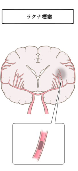ラクナ梗塞　画像