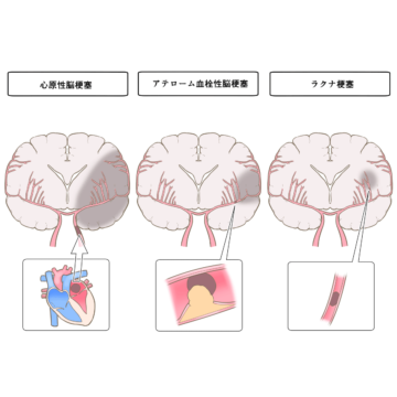 脳卒中　イメージ画像