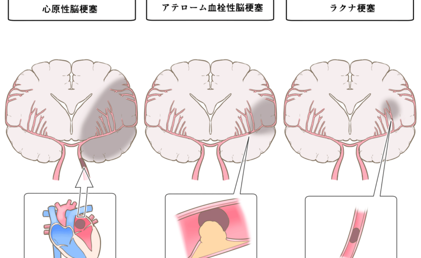 脳卒中　画像