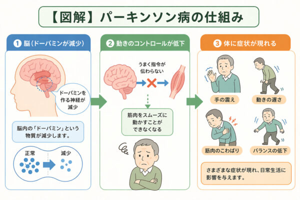 パーキンソン病の仕組み